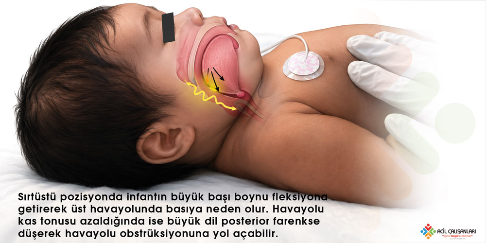 Pediatrik dil ve üst havayolu obstrüksiyonu