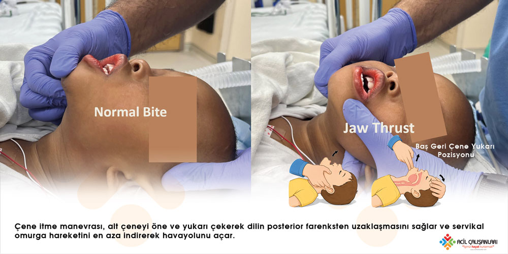 Çene itme jaw-thrust manevrası