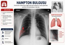 Hampton Hörgücü (Hampton Hump)