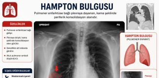 Hampton Hörgücü (Hampton Hump)