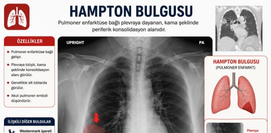 Hampton Hörgücü (Hampton Hump)