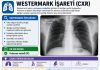 Westermark Bulgusu (İşareti)