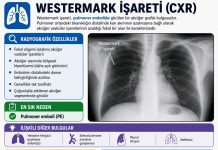 Westermark Bulgusu (İşareti)