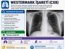 Westermark Bulgusu (İşareti)