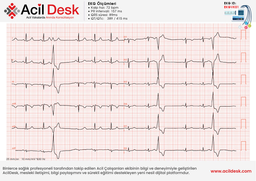 Başvuru EKG'si