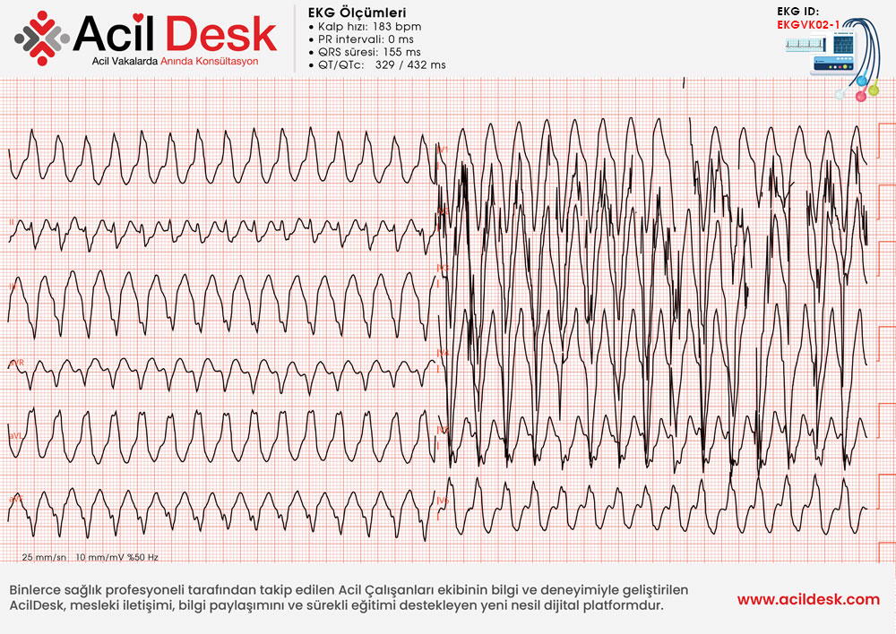 Başvuru EKG'si