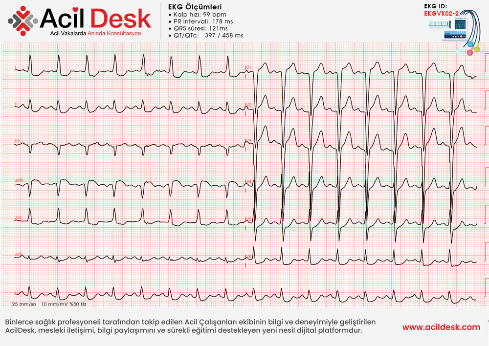 Acil Servis EKG
