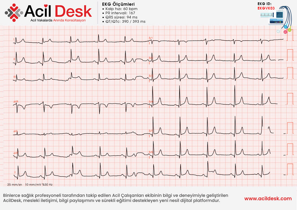 Başvuru EKG'si