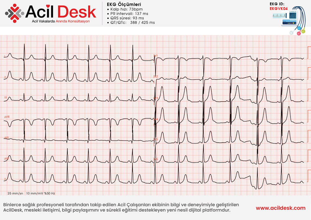 Başvuru EKG'si