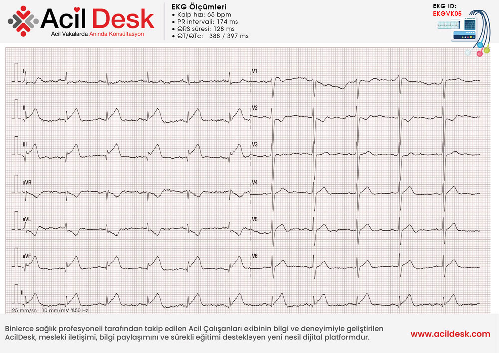 Başvuru EKG'si