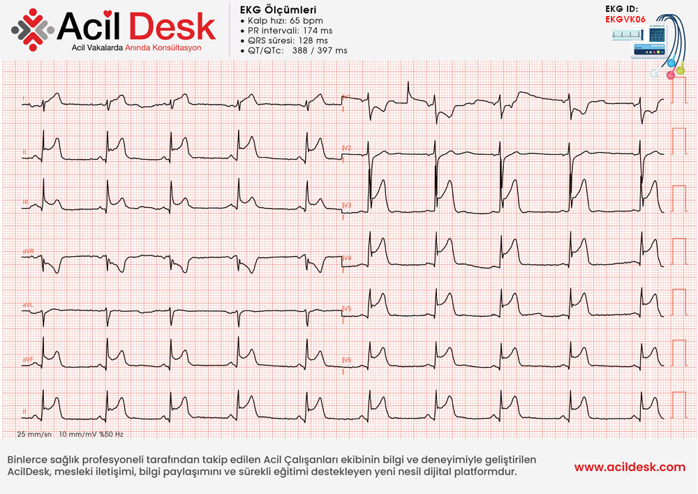 Başvuru EKG'si