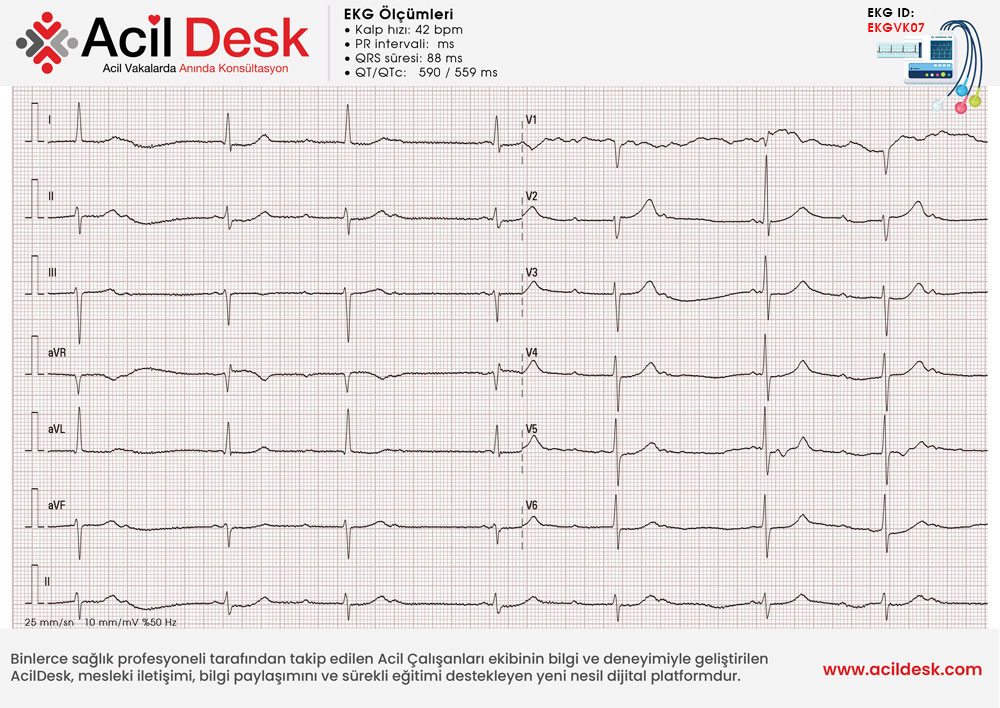 Başvuru EKG'si