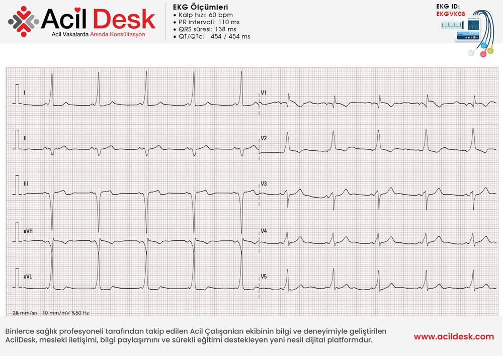 Başvuru EKG'si