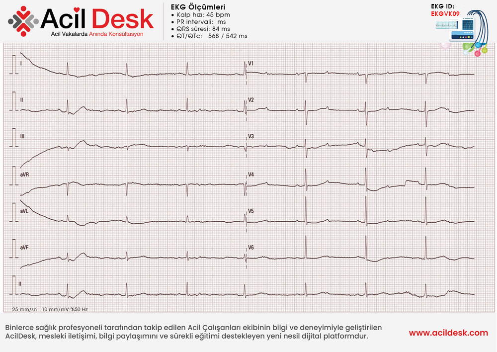 Başvuru EKG'si