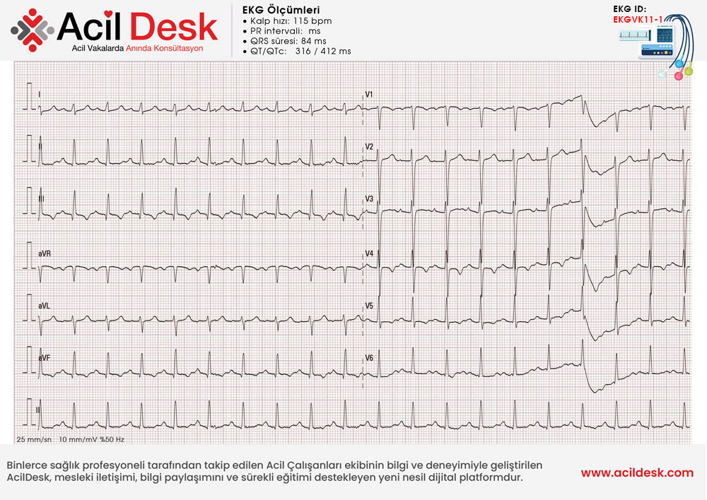 Başvuru EKG'si