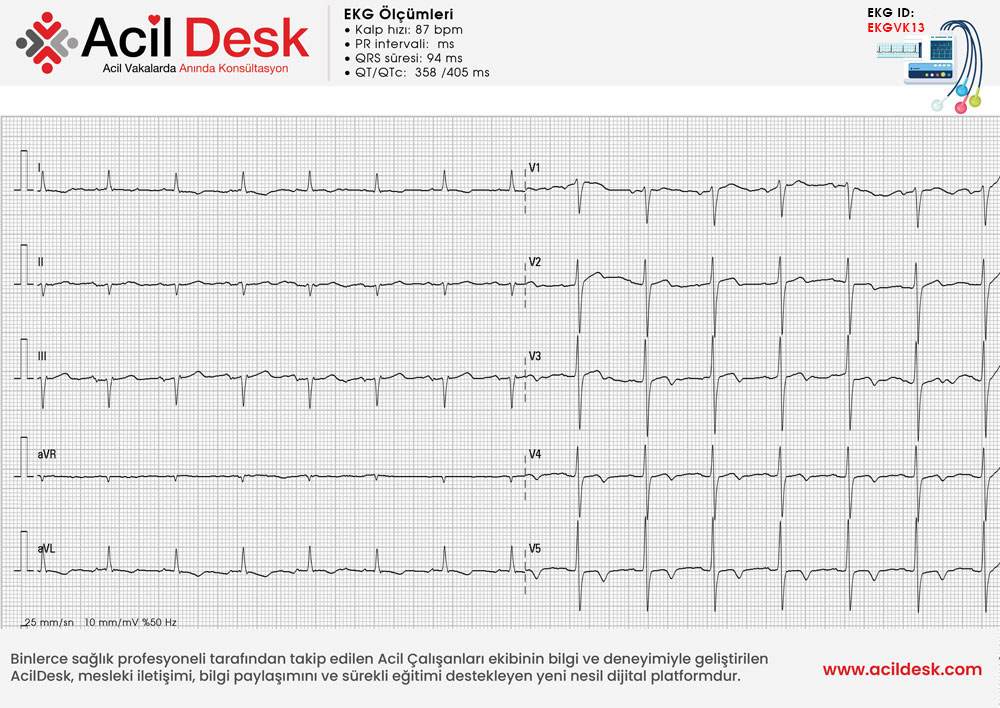 Başvuru EKG'si