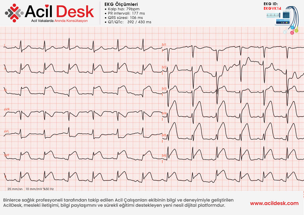 Başvuru EKG'si