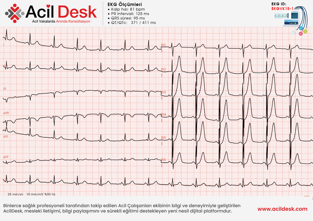 Başvuru EKG'si