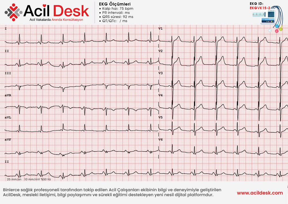 Kontrol EKG
