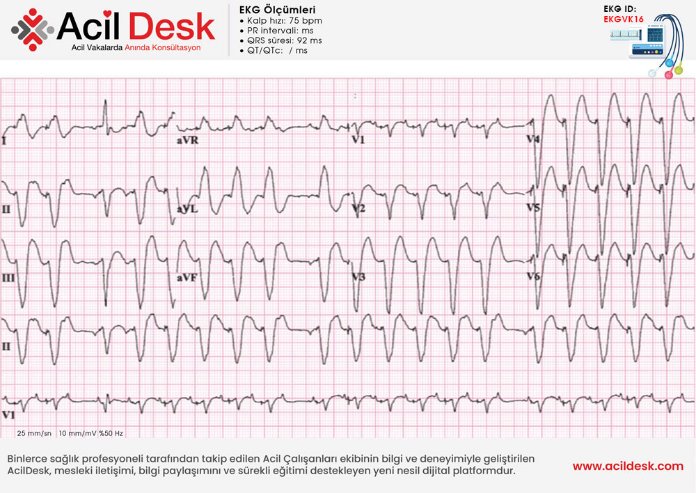 Başvuru EKG'si