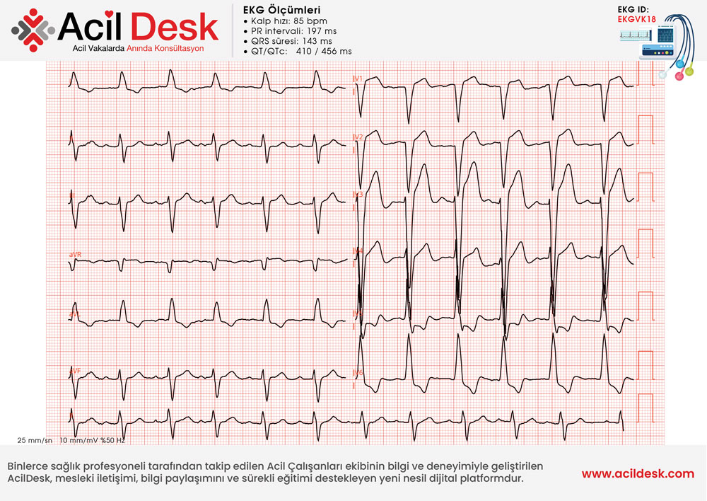 Başvuru EKG'si