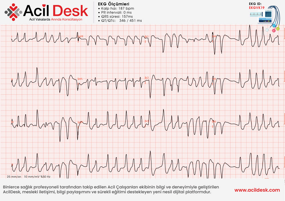 Başvuru EKG'si