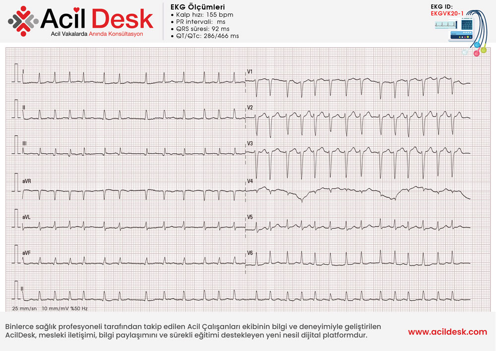 Başvuru EKG'si