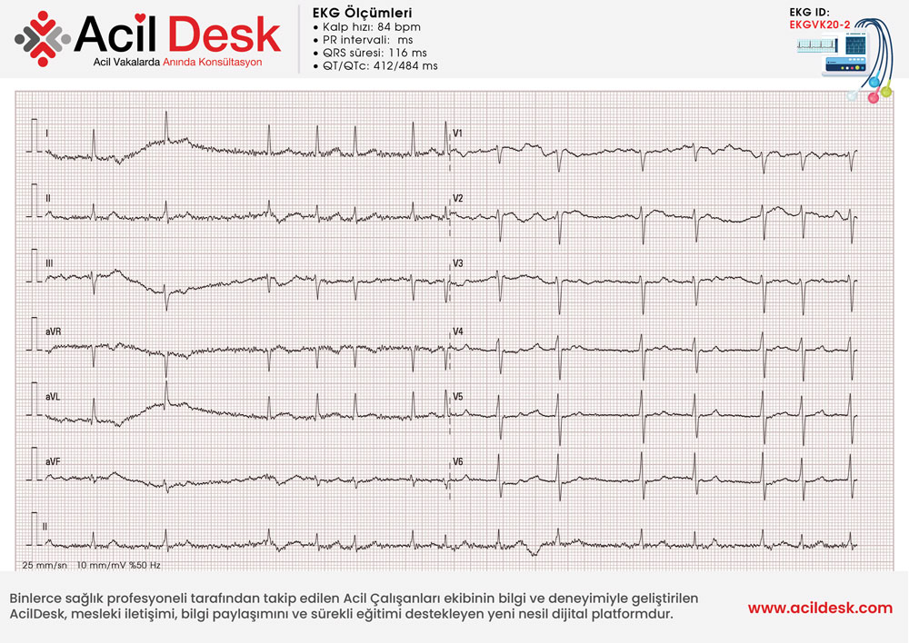 Acil Servis EKG