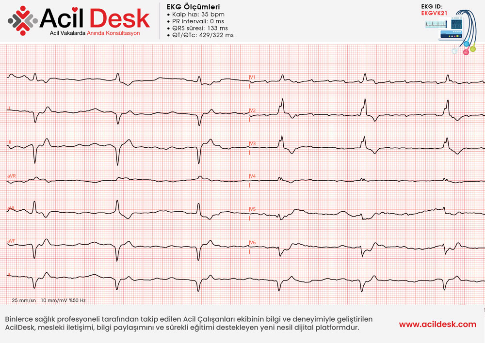 Başvuru EKG'si